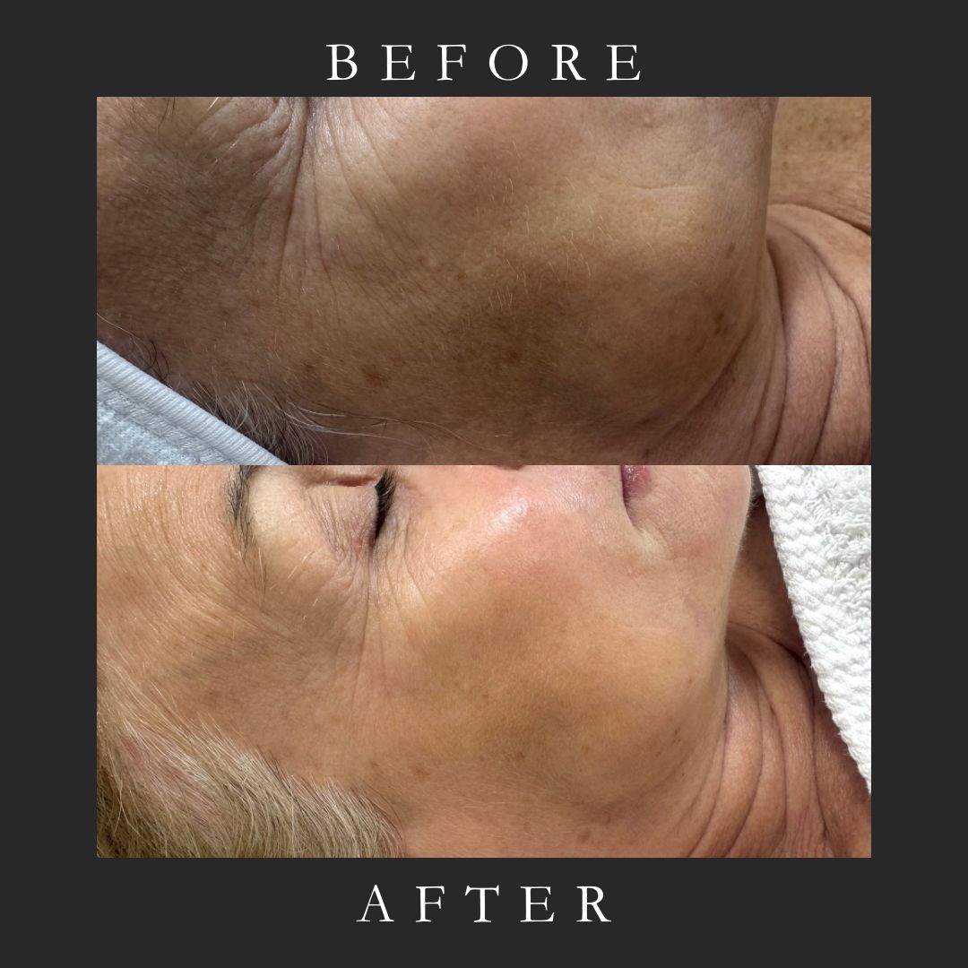 Pigmentation Peel In West Kensington
