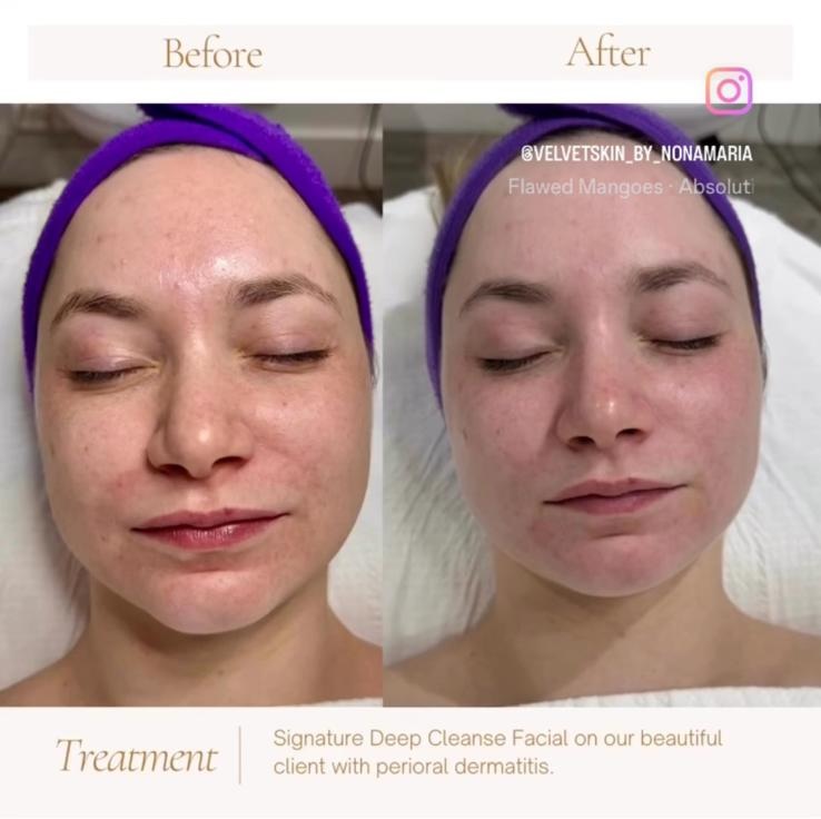 Micro Hydro Facial in West Kensington, London