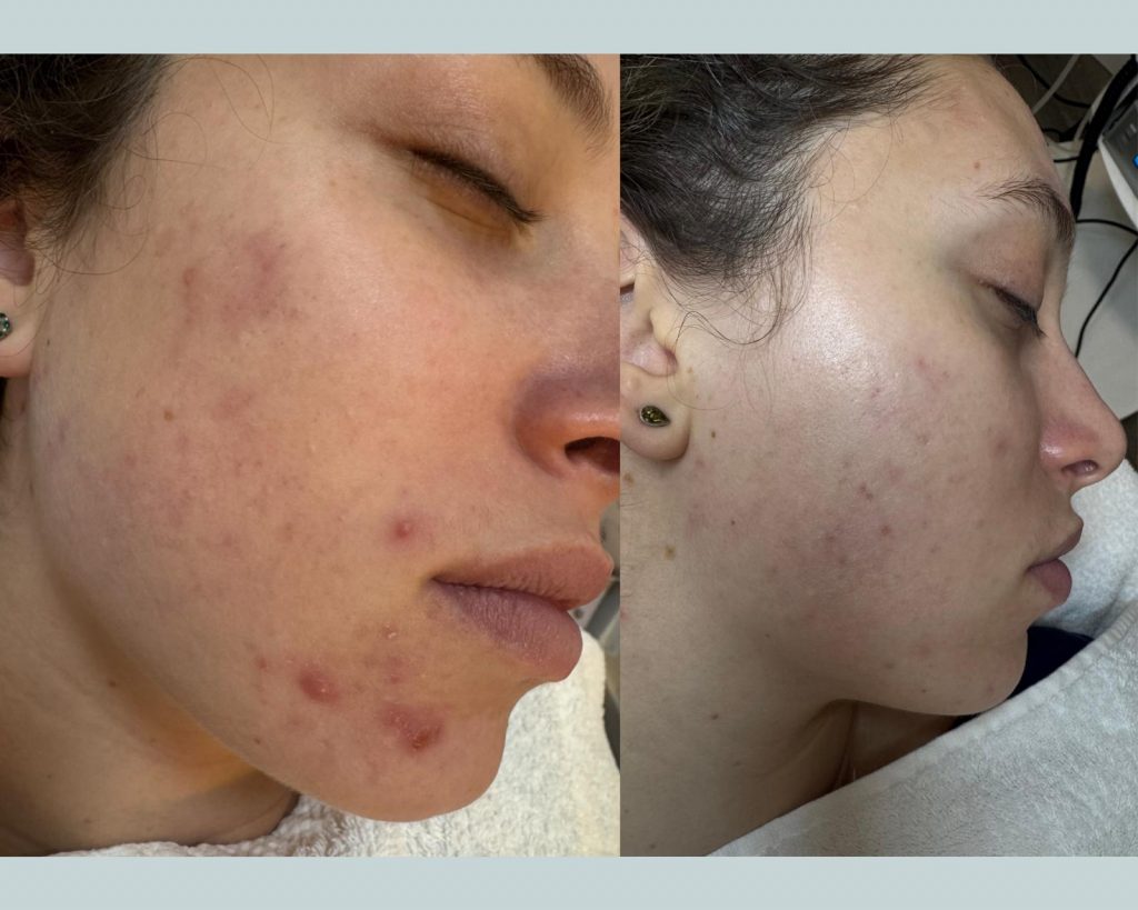 Microneedling Treatment in West Kensington London