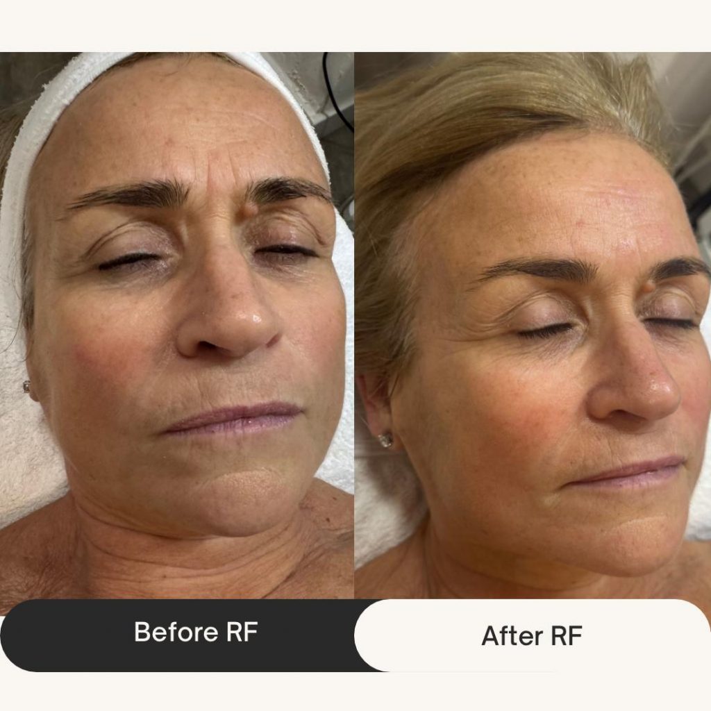 Radio Frequency Skin Tightening in West Kensington, London