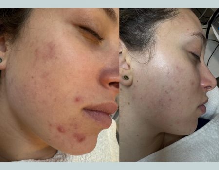Microneedling Treatment in West Kensington London