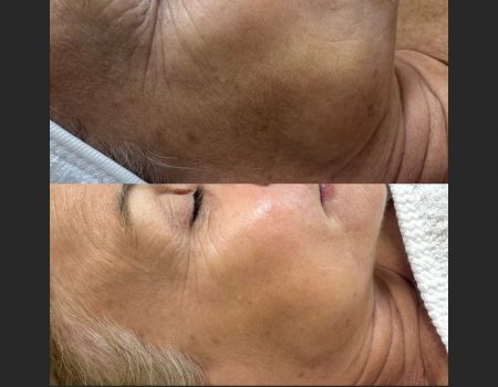 Pigmentation Peel In West Kensington