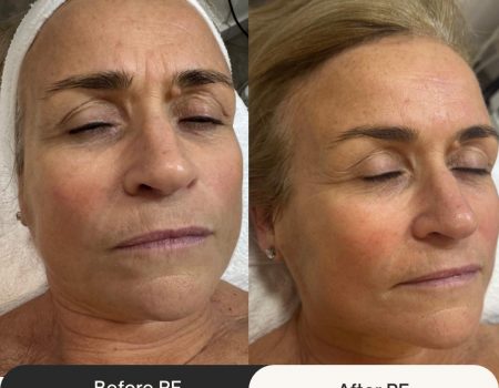 Radio Frequency Skin Tightening in West Kensington, London